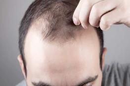  سلول‌های پیر راه‌گشای درمان طاسی می‌شوند